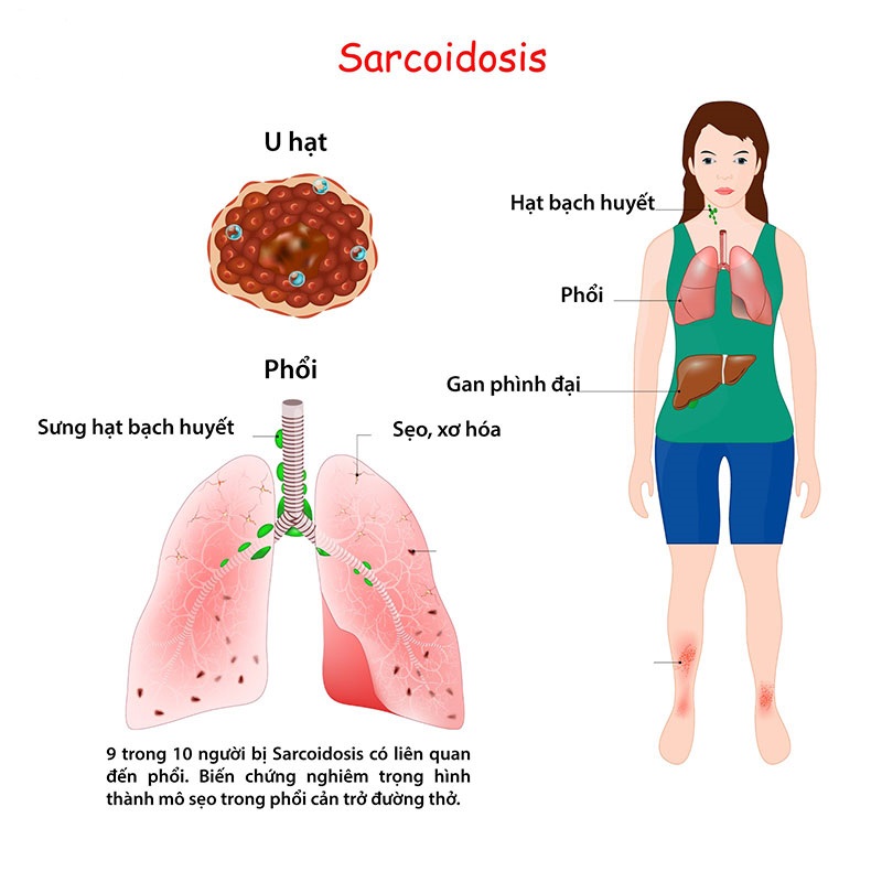 Biến chứng bệnh Sarcoidosis gây ảnh hường đến rất nhiều cơ quan 